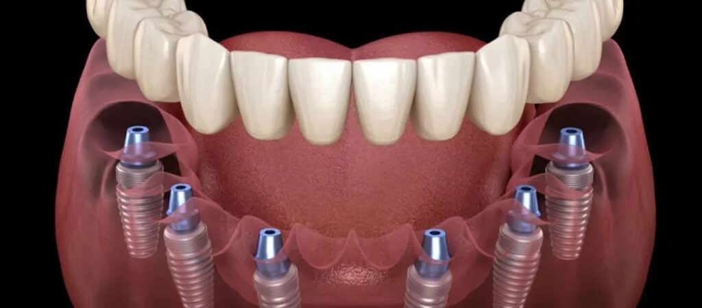 Advantages of Getting Your All on 6 Dental Implants