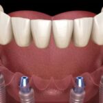 Advantages of Getting Your All on 6 Dental Implants
