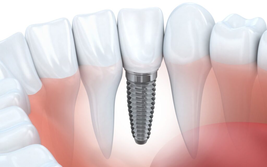 Are Dental Implants the Best Tooth Replacement Options?