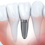 Are Dental Implants the Best Tooth Replacement Options?