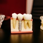 Check Out Our 7 Tips For Optimal Aftercare Of Dental Implants!