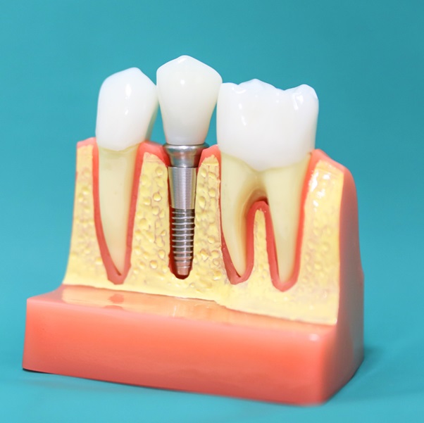 Check Out Our 7 Tips For Optimal Aftercare Of Dental Implants!