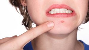 Fed Up With An Acne Problem, Get Complete Details Below