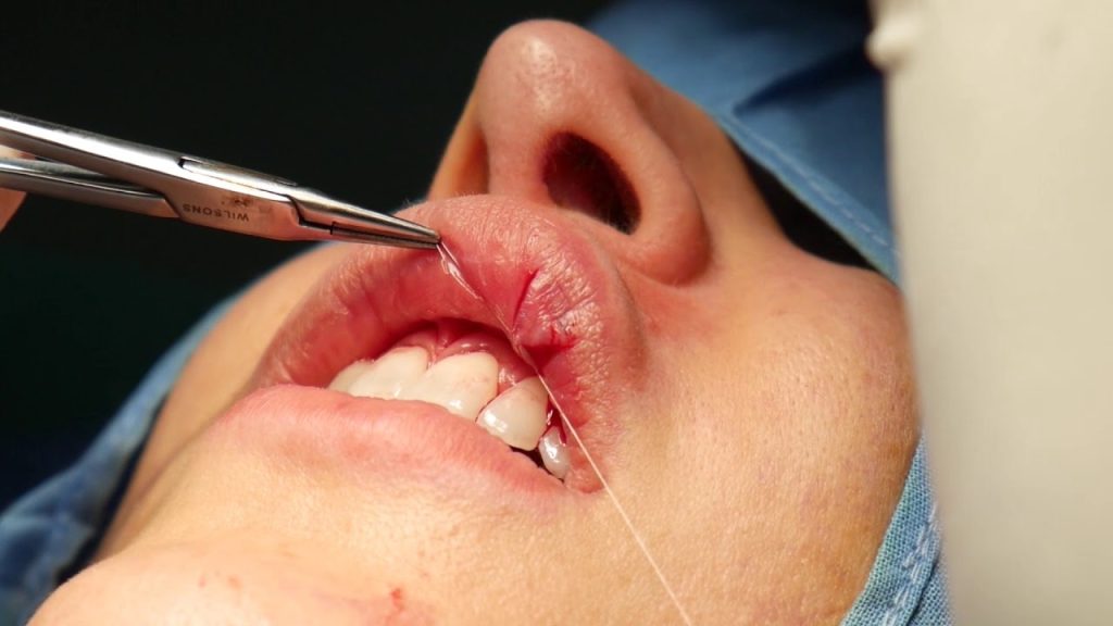 What Is Lip Surgery?