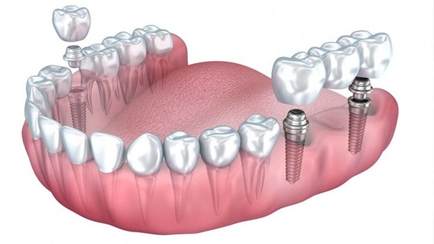 Which Dental Implant Is Right for Me?