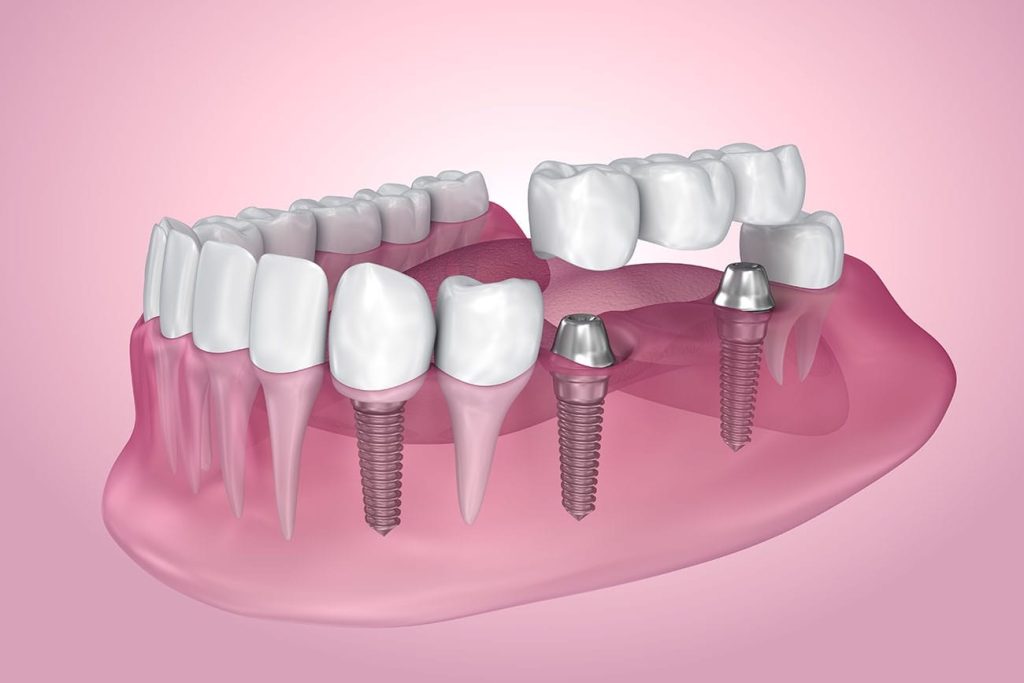 Which Dental Implant Is Right for Me?