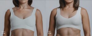How Does Mia Breast Augmentation Work? A Closer Look at the Procedure
