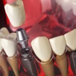 Dental (1)