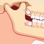 Wisdom Teeth and Jaw Pain_ When Should You Consult an Oral Surgeon_