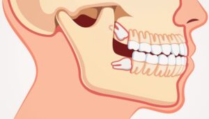 Wisdom Teeth and Jaw Pain_ When Should You Consult an Oral Surgeon_