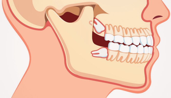 Wisdom Teeth and Jaw Pain_ When Should You Consult an Oral Surgeon_